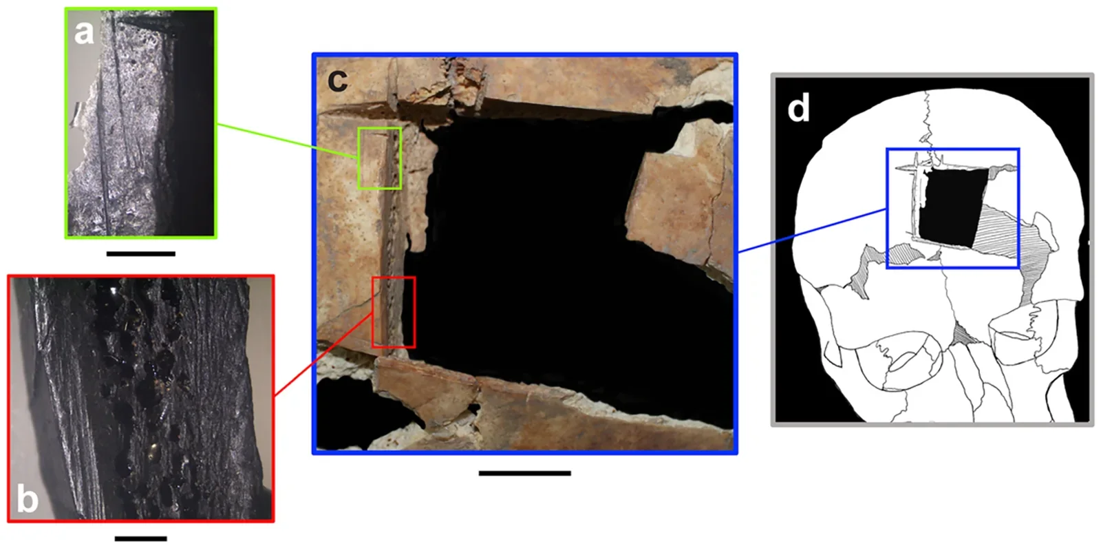 Figura científica con la abertura craneal, detalles microscópicos y esquema de posición de la trepanación de Megido